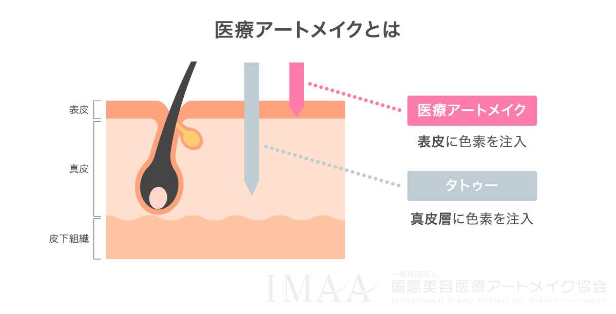 医療アートメイクとタトゥーの違い